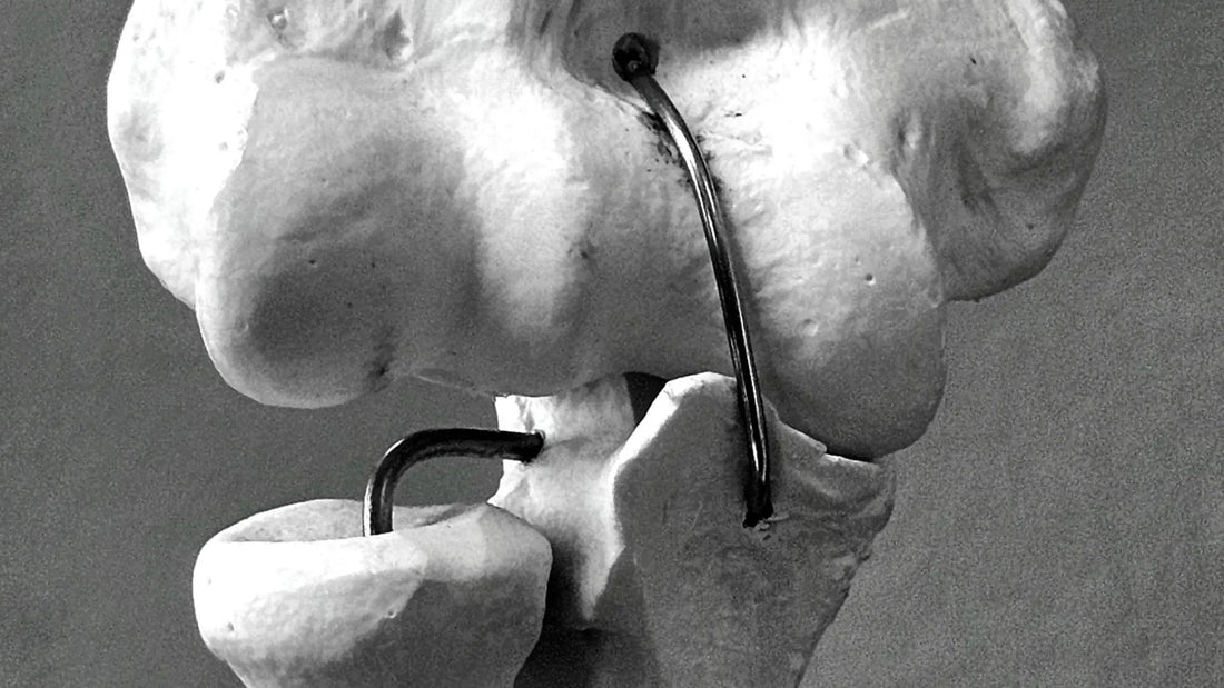 Artroplastika