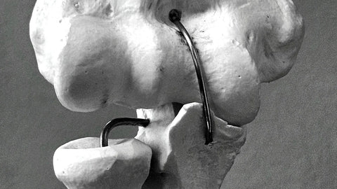 Artroplastika: Kai Sąnarys Nebegali Atsikovoti Pats