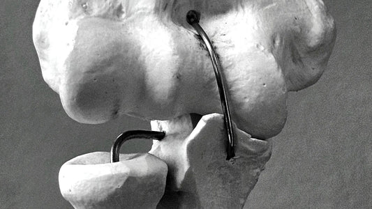 Artroplastika