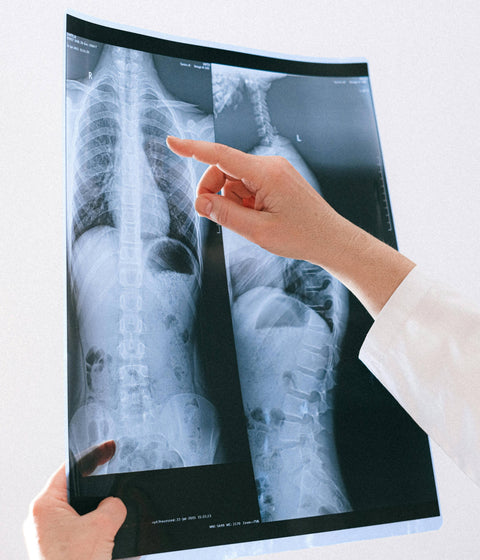 Idiopatinė skoliozė: kas tai ir kaip ją atpažinti?